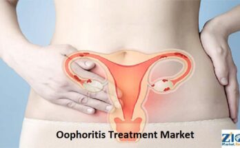 Oophoritis Treatment Market